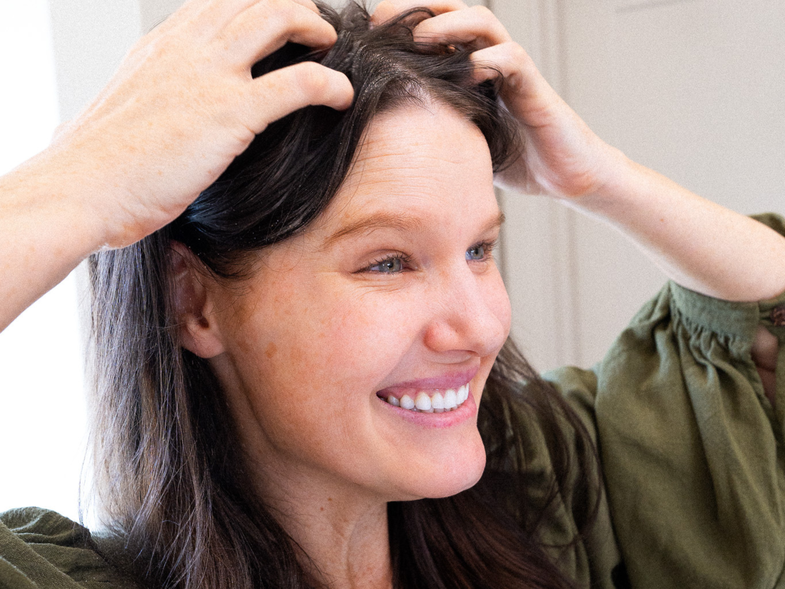 Melasma: What It Is & How To Address It